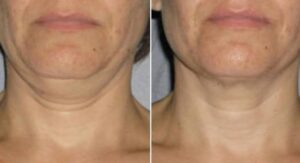ultherapy